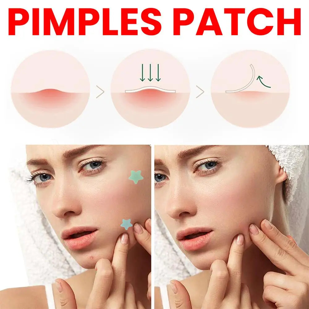 🌟 StarGlow Acne Patch – Cute, Powerful, and Skin-Friendly